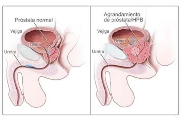 problemas-próstata-curso-de-tantra-taller-de-tantra-formación-de-tantra-hari-dass
